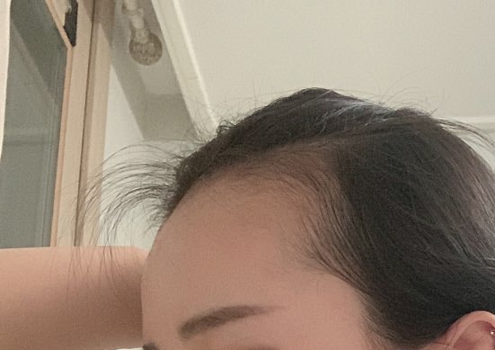 헤어라인 이식 전 2