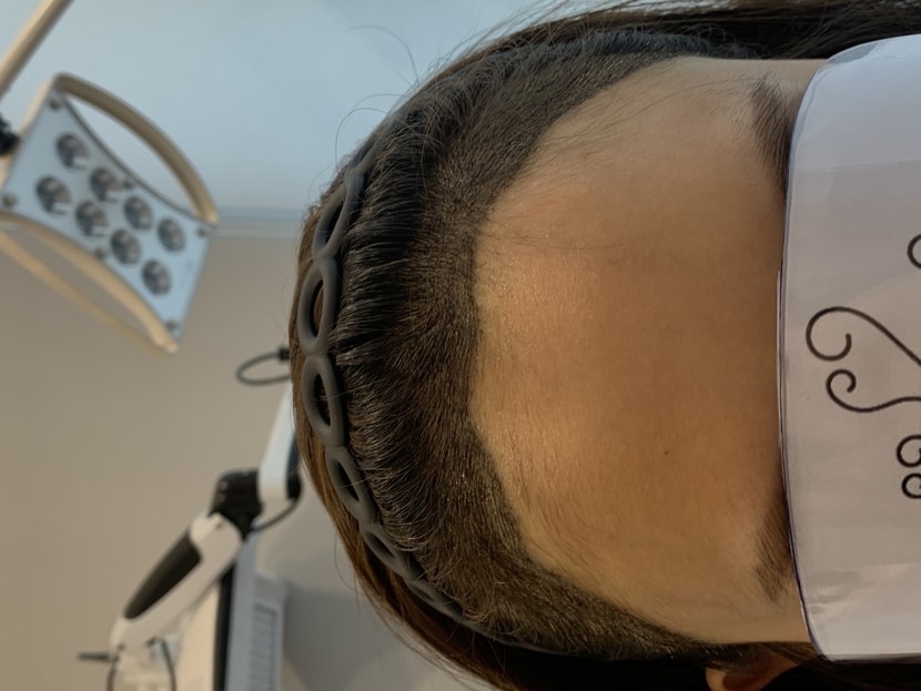 10일차 지문 샴푸후 각질 본격적으로 올라옴