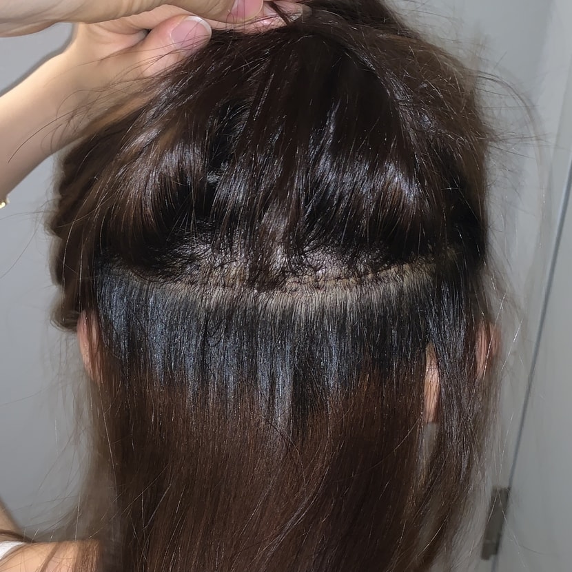 수술후 2일째? 쯤-후두부를 꼼꼼하게 해주셔서 벌어짐이나 덧남은 없었어요