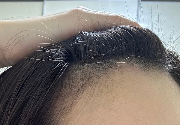 62일 사진 / 빠진 머리 자라기 시작하니까 밤송이 됐네요.. 집에서 찍어본다고 열심히 찍었는데 똥손이라 이해해주세용^^