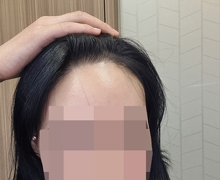수술 10개월