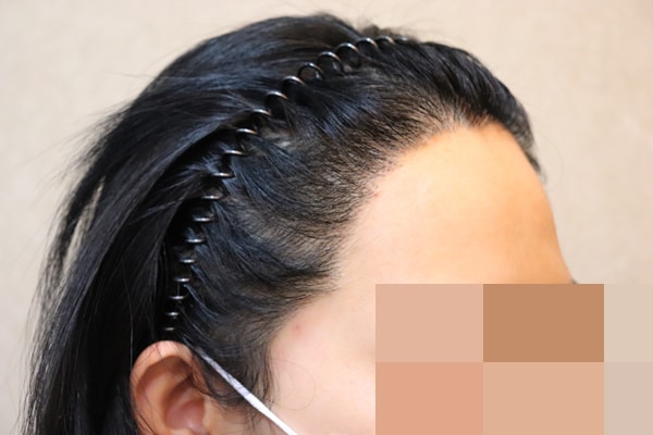 오른쪽 수술전 후