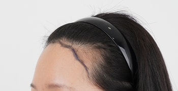 수술전 디자인