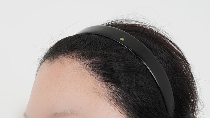 왼쪽 수술전, 수술 후