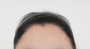 정면 수술전, 수술 후