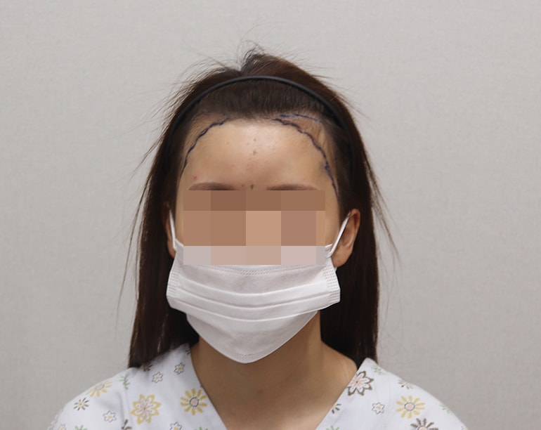 수술전 디자인하고 촬영 