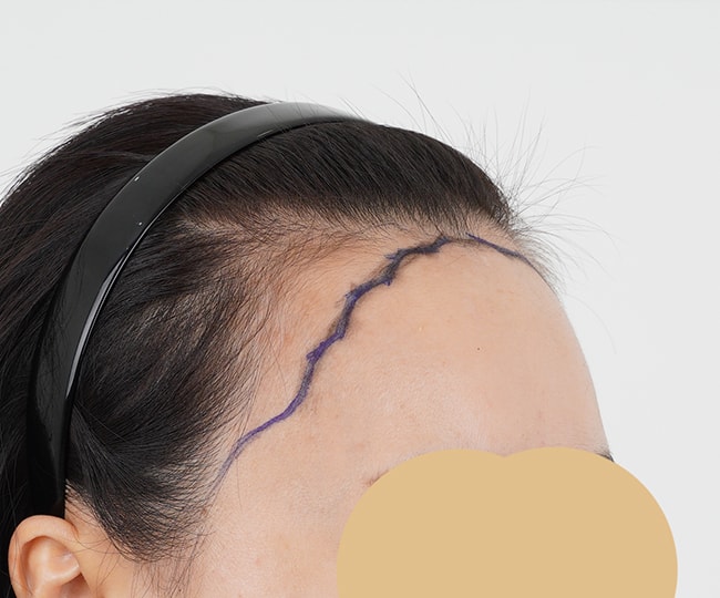 수술전에 디자인하고 찍은 사진