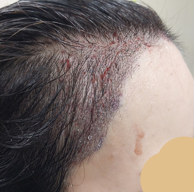 수술직후에 찍은 사진