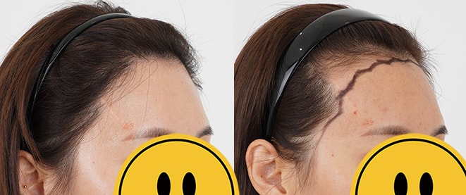 수술 10개월 / 수술전