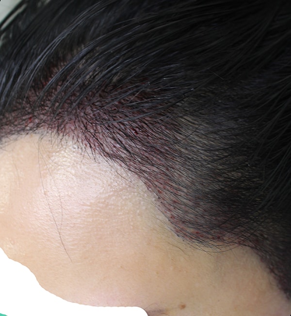 헤어라인 모발이식 직후