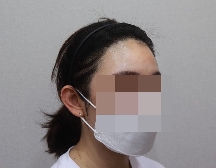 ﻿1년3개월 경과-오른쪽 측면