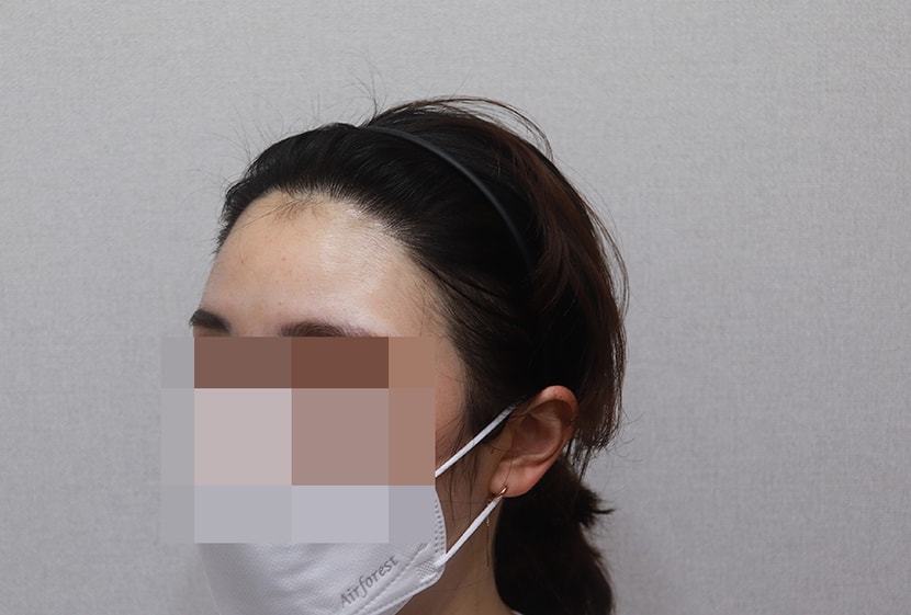 ﻿1년3개월 경과-왼쪽 측면