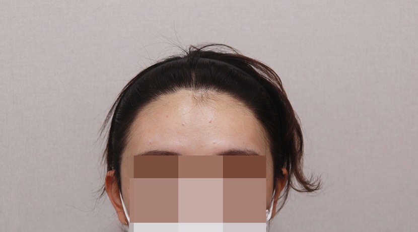 ﻿1년3개월 경과-앞머리 올리고 찍은 거