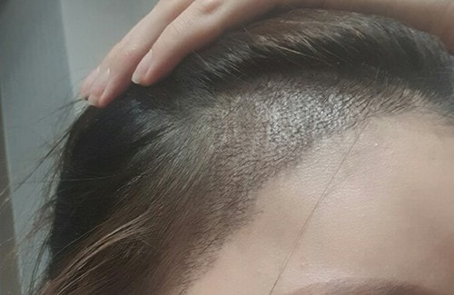 월요일에 병원가서 2주케어 받고왔어요 에어젯으로 각질 털어주셨는데 각질없어져서 좋은거 같아요