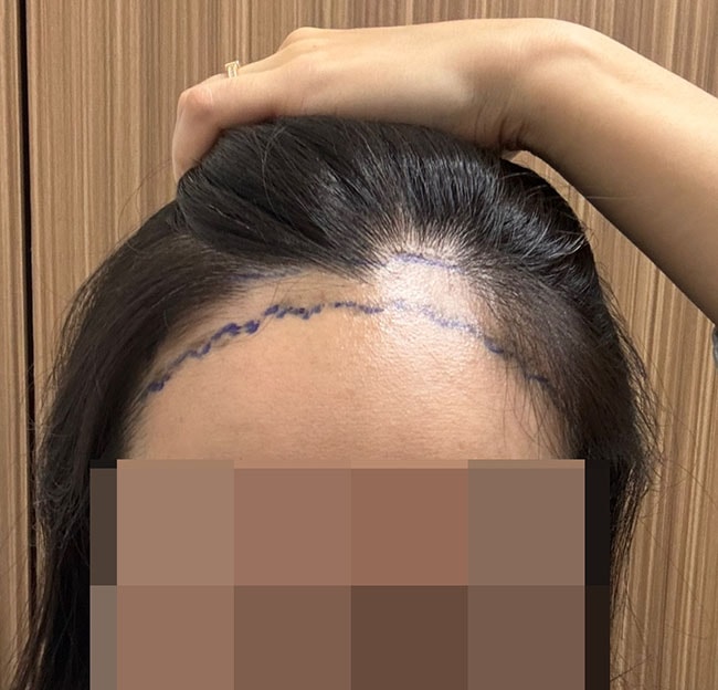 수술 전 디자인
