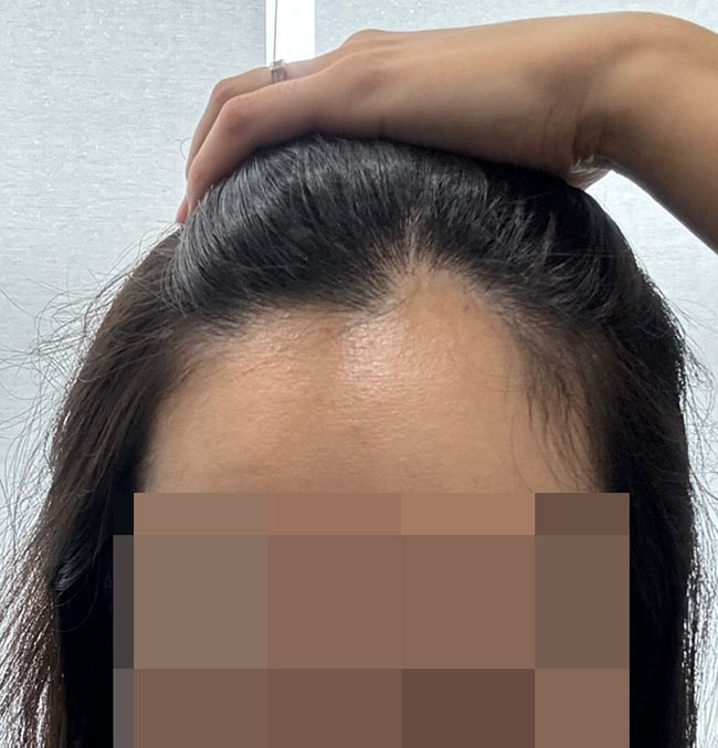 수술 전