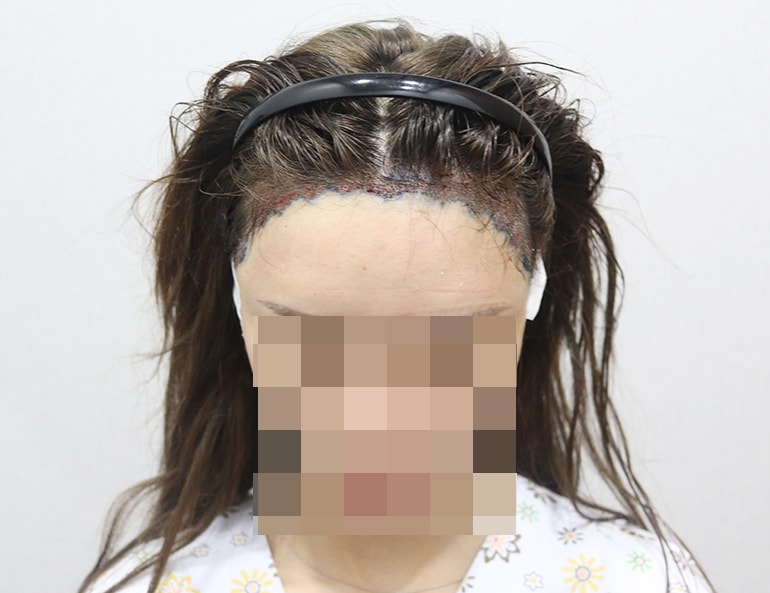 수술하고 찍은 사진