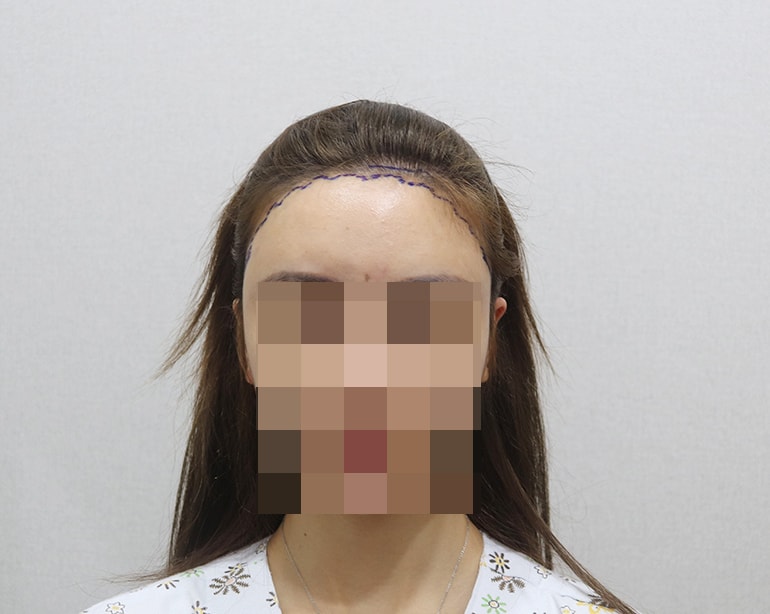 디자인하고 찍은 사진이에요 원장님이 디자인 그려주실 때 라인을 더 내릴 수 없냐고 여쭤봤는데 원장님 단호박!! 답답해보인다고 절대 안된다고 하셨습니다 반영구 했던 라인 위주로만 채워주셨어요ㅠㅠㅠ 추가비용 발생하더라도 좀만 더 내리고 싶었는데 아쉬웠어요 그래도 디자인 예뻐서 만족 '-'