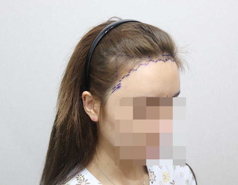 수술전사진 