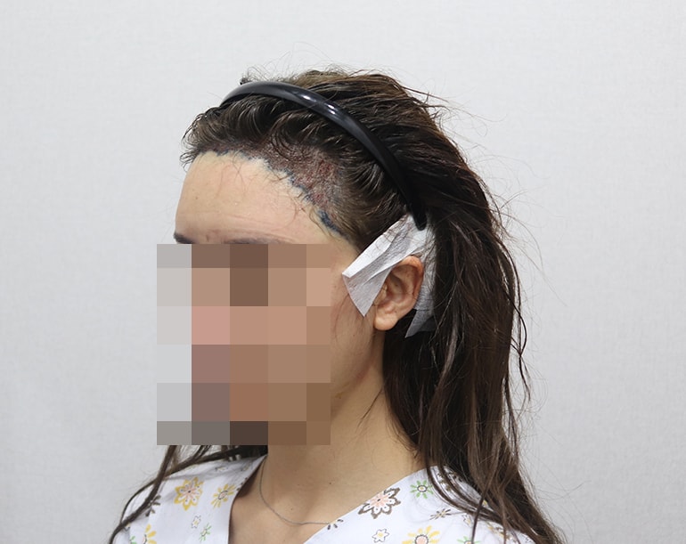 수술하고 찍은 사진