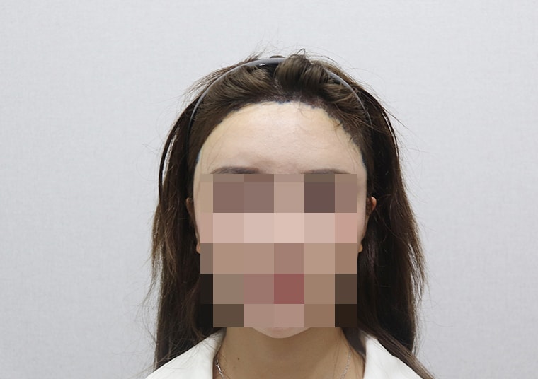 수술다음날 샴푸/소독/레이져 받고 찍은 사진 