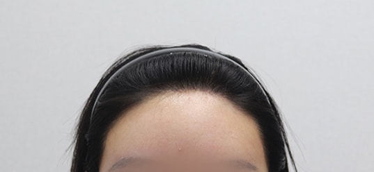 4년6개월 사진 (진한색으로 염색해서 더 짙어보이지만 2년전이랑 크게 다른 거 없어요)