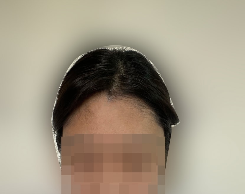 헤어라인 수술 후_1년 이상