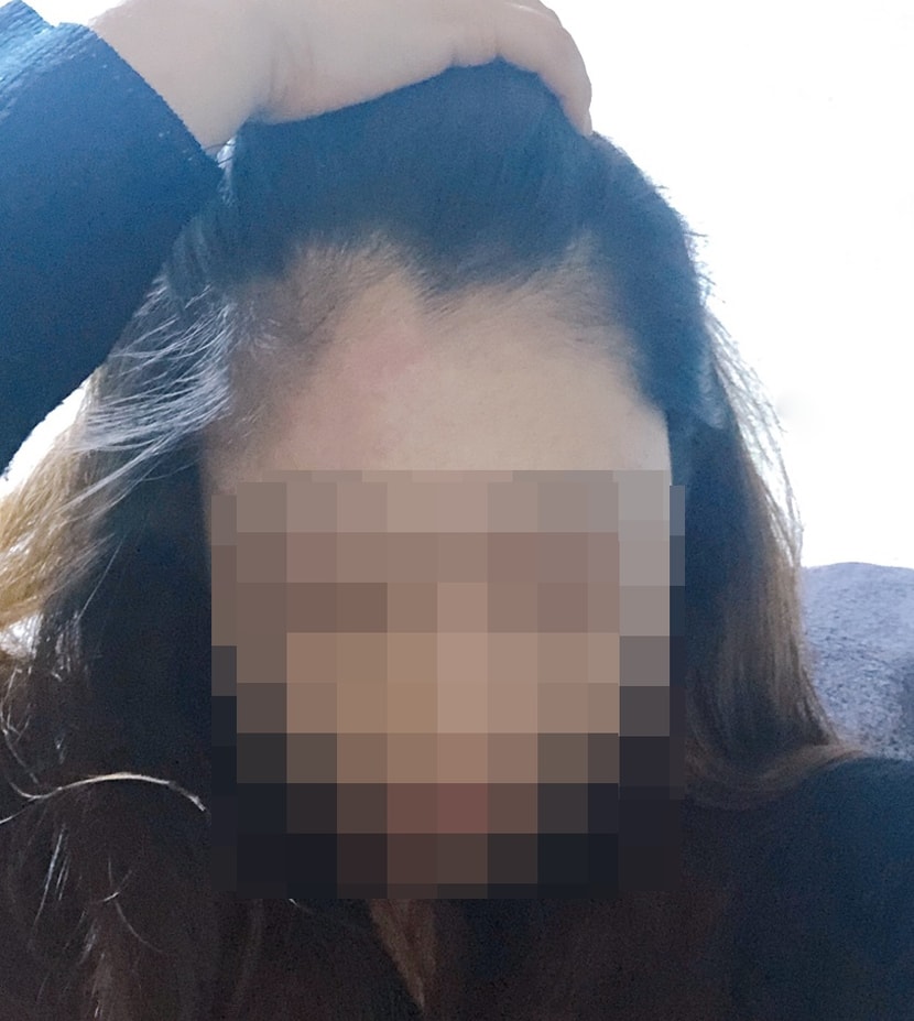 헤어라인 수술 전