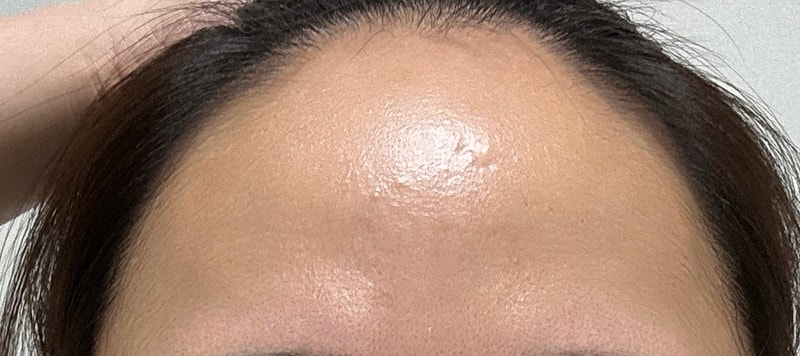 [MOOLIM] 发际线 毛发移植后期