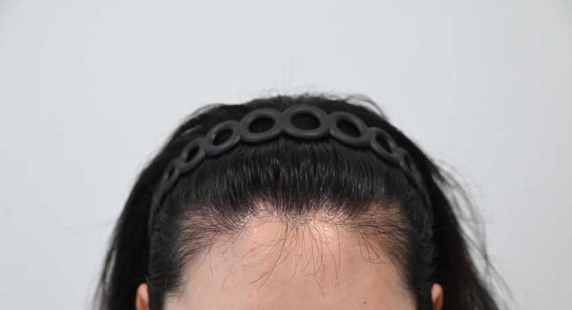 수술 3개월차