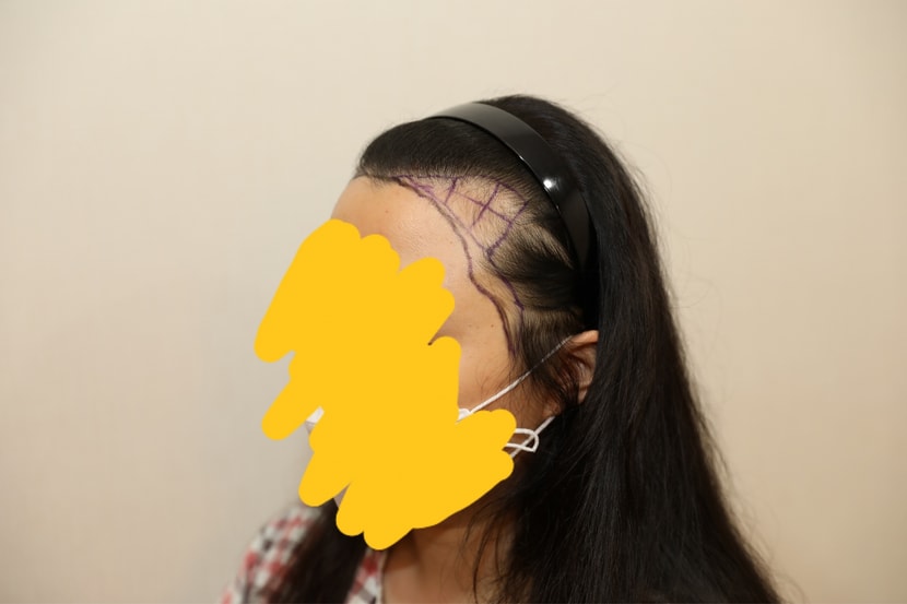 수술 전 디자인