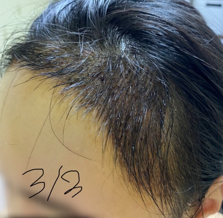 수술 10일차(지문샴푸 전)