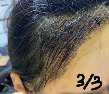 수술 10일차(지문샴푸 전)