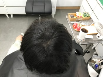 시술 전2