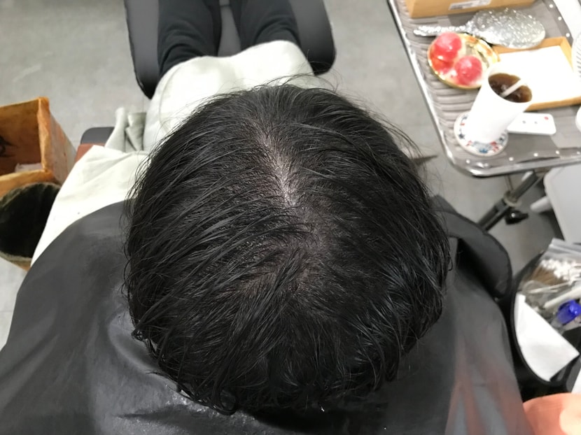 시술 전1