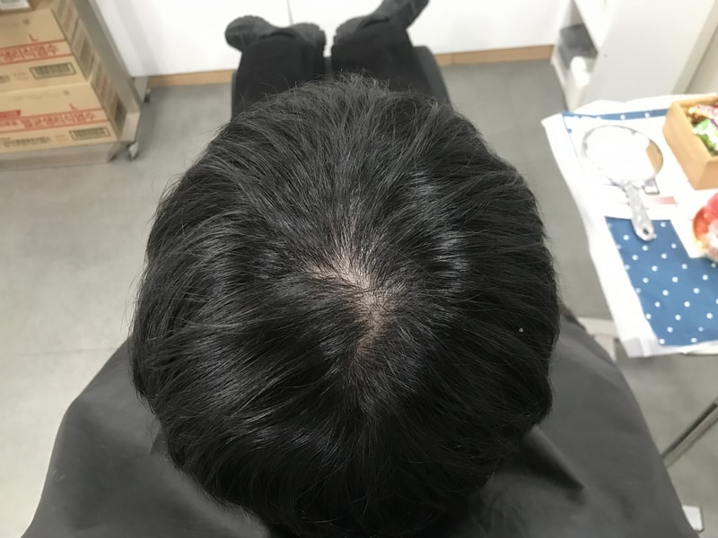 초기탈모 두피문신 후기