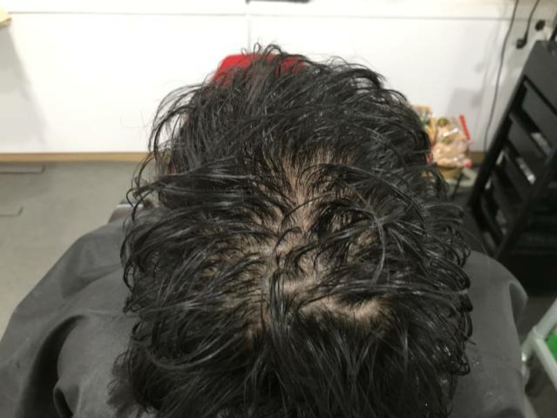 上传头皮纹身后记（1次，2次）