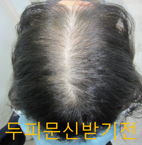 한나이브 두피문신 2회까지 받고 왔어요~