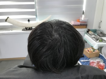 2023년도 3월 두피 리터치 전 젖은모발
