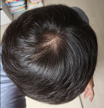 2022년도 7월 약 복용 후 사진입니다.