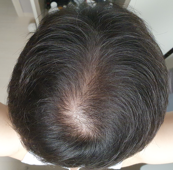 2021년도 6월 약 복용 전의 사진입니다.