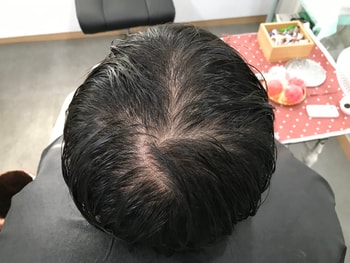 2023년도 1월 두피 시술 전 젖은모발