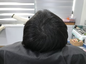 2023년도 3월 두피 리터치 전 일반모발
