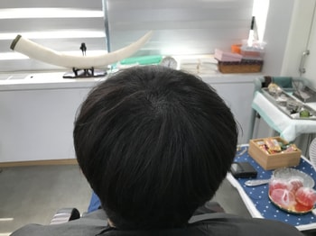 2023년도 3월 두피 리터치 후 일반모발