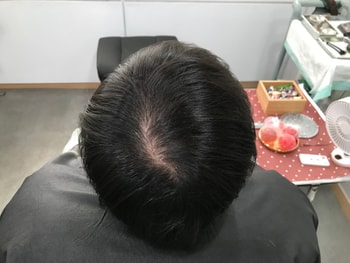 2023년도 1월 두피 시술 전 일반모발