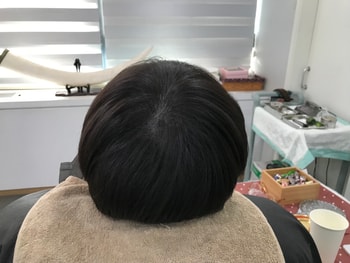 2023년도 1월 두피 시술 후 일반모발