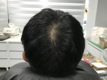 시술전 사진