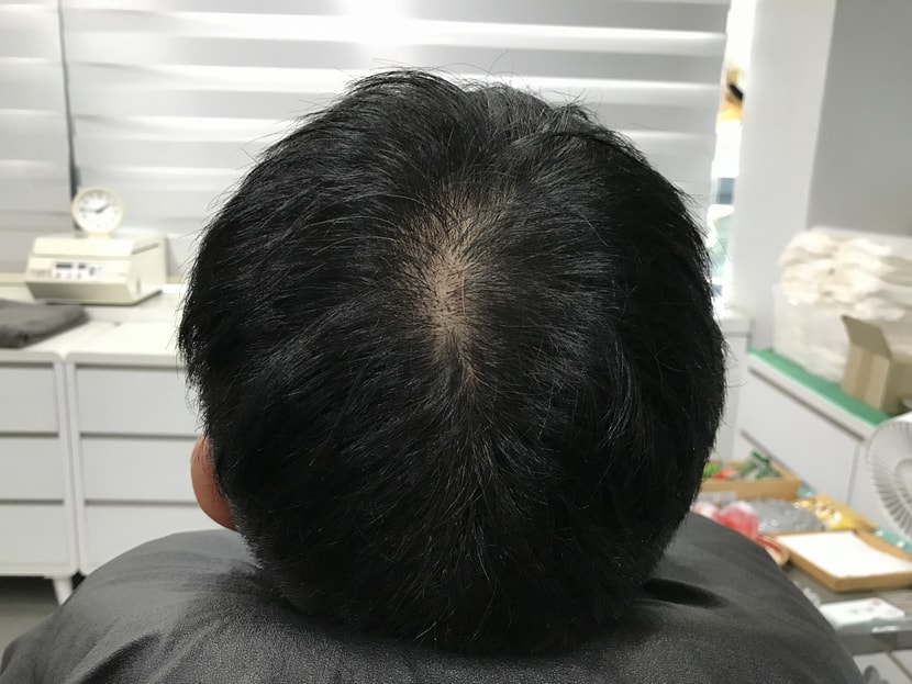 시술전 사진