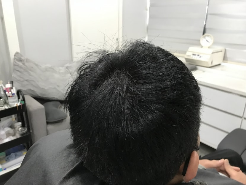 1차 시술 직후 사진