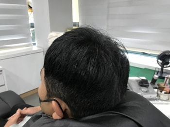 1차 시술 직후 사진